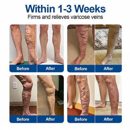 🎁 Only 5 boxes left! We're offering an extra 50% off! 🦵 Say goodbye to tired, heavy, and swollen legs. Start your journey to lighter, more comfortable legs today — you won’t want to miss this special offer!