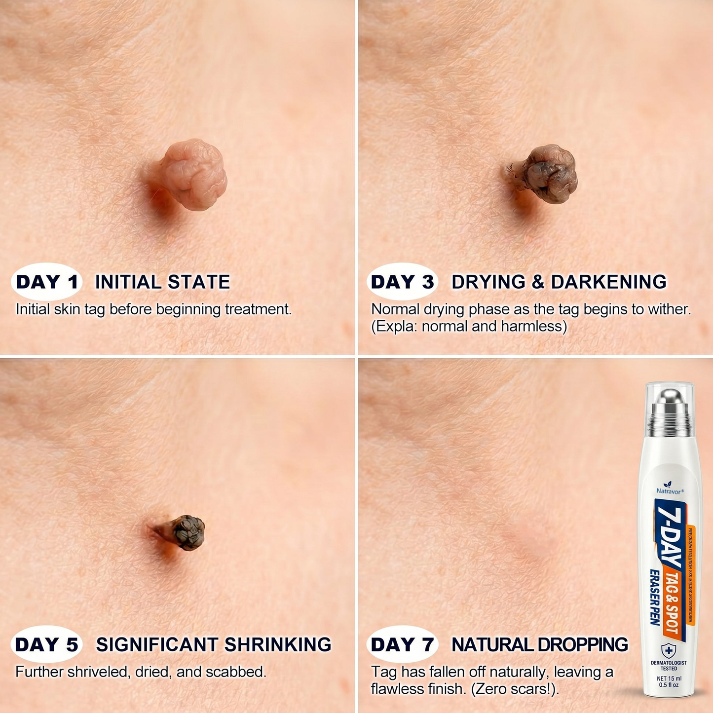 🩺𝐎𝐟𝐟𝐢𝐜𝐢𝐚𝐥 𝐁𝐫𝐚𝐧𝐝 𝐒𝐭𝐨𝐫𝐞 |✅Natravor® 7-𝐷𝑎𝑦 𝗧𝐚𝐠 & 𝗦𝗽𝐨𝐭 𝐄𝐫𝒂𝒔𝒆𝒓(Zero Pain, Zero 𝐒𝐜𝐚𝒓𝒔 Rollerball)