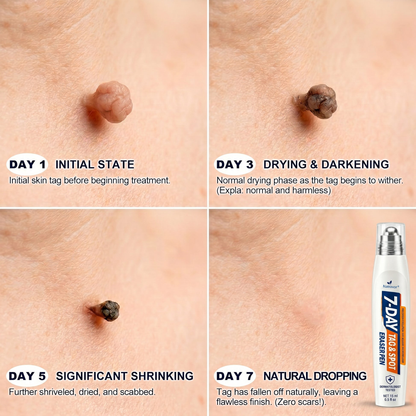 🩺𝐎𝐟𝐟𝐢𝐜𝐢𝐚𝐥 𝐁𝐫𝐚𝐧𝐝 𝐒𝐭𝐨𝐫𝐞 |✅Natravor® 7-𝐷𝑎𝑦 𝗧𝐚𝐠 & 𝗦𝗽𝐨𝐭 𝐄𝐫𝒂𝒔𝒆𝒓(Zero Pain, Zero 𝐒𝐜𝐚𝒓𝒔 Rollerball)